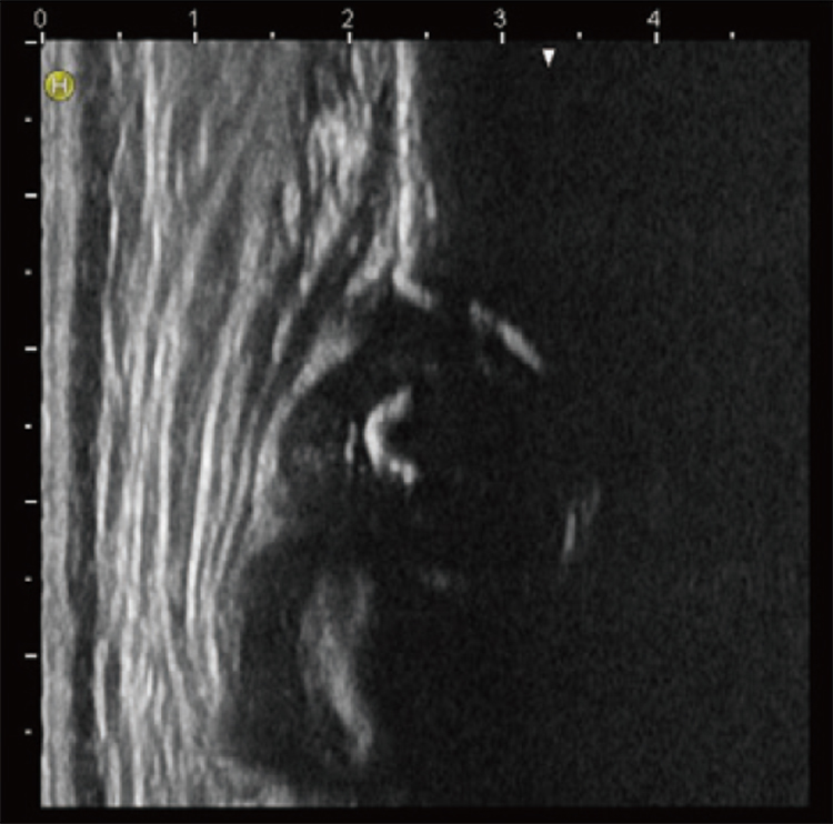 乳児股関節の超音波画像