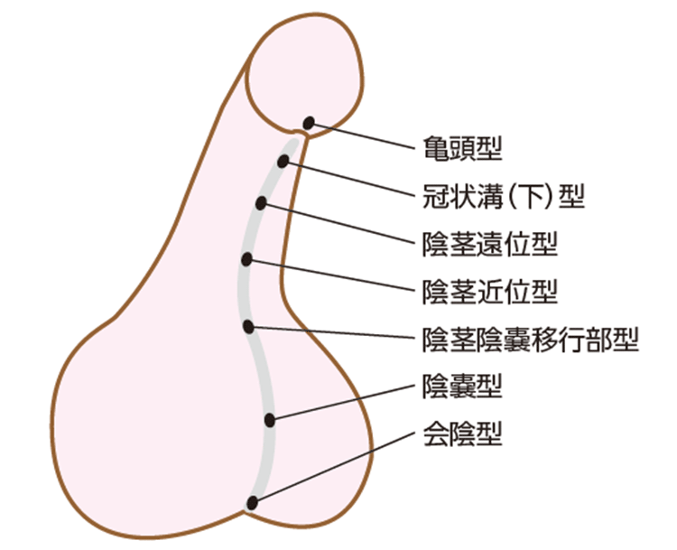亀頭型、冠状溝（下）型、陰茎遠位型、陰茎近位型、陰茎陰嚢移行部型、陰嚢型、会陰型