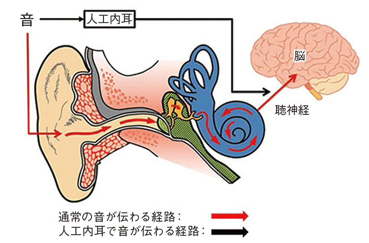 人工内耳で音が伝わる経路。音→(通常の音が伝わる経路)聴神経→(通常の音が伝わる経路)→脳/音→(人工内耳で音が伝わる経路)人口内耳→(人工内耳で音が伝わる経路)聴神経→(人工内耳で音が伝わる経路)→脳