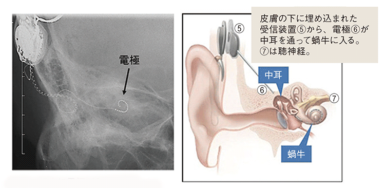左　蝸牛に電極が入っているX 線 / 右　人工内耳のしくみ（受信装置から蝸牛へ）。皮膚の下に埋め込まれた受信装置から、電極が中耳を通って蝸牛に入る。蝸牛の奥は聴神経。
