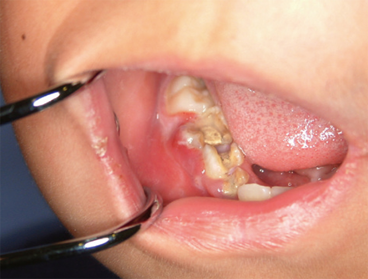 右下奥歯のむし歯を放置した結果、歯肉から頬まで腫れました。
切開排膿を行った後、歯科処置を開始しました