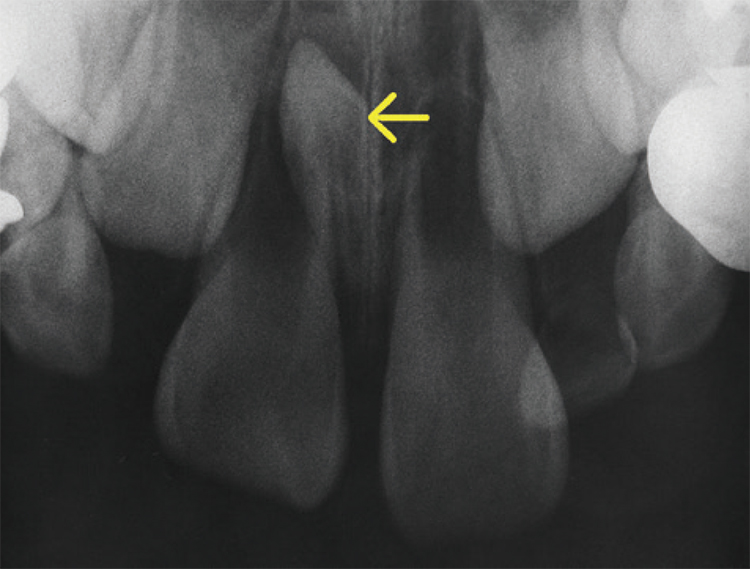 上顎前歯部の埋伏過剰歯（骨の中にある余分な歯）。
歯列不正の原因となるので、抜歯が必要となります