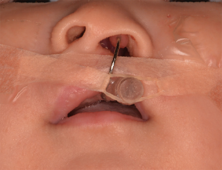 唇顎口蓋裂（しんがくこうがいれつ）の乳児に、PNAM（＊）床を装着しました。
その後、口唇裂（こうしんれつ）、口蓋裂の手術を行いました