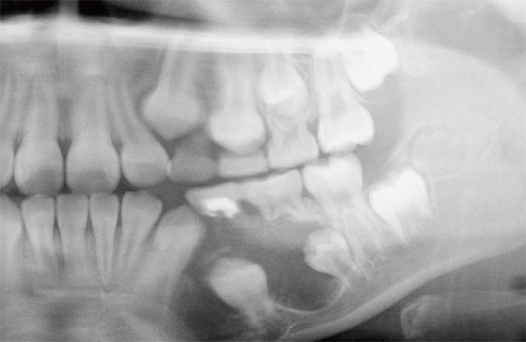 下顎の顎骨嚢胞（がっこつのうほう、骨の中の病的な袋）。
周囲の歯や骨が吸収されるので、手術が必要です