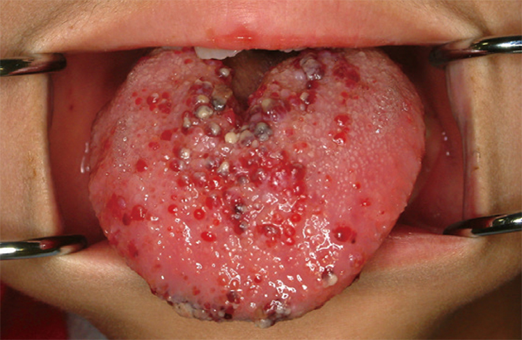 舌リンパ管腫。風邪をひくと、さらに舌が腫れます。
舌を縮小する手術を行いました